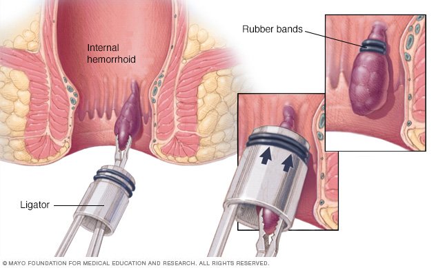 What Urgent Care Does For Hemorrhoids: A Comprehensive Overview